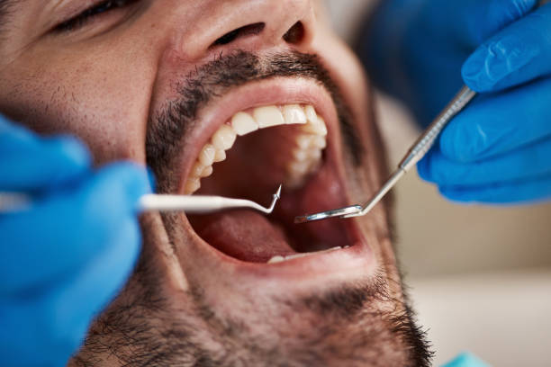 Best Emergency Dentist for Knocked-Out Tooth in Huntingtown, MD