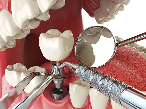 Best Emergency Dental Care for Abscessed Tooth in Huntingtown, MD